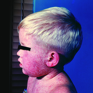 300X300 Measles Sideprofile