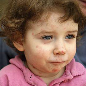 Chicken Pox 278X278