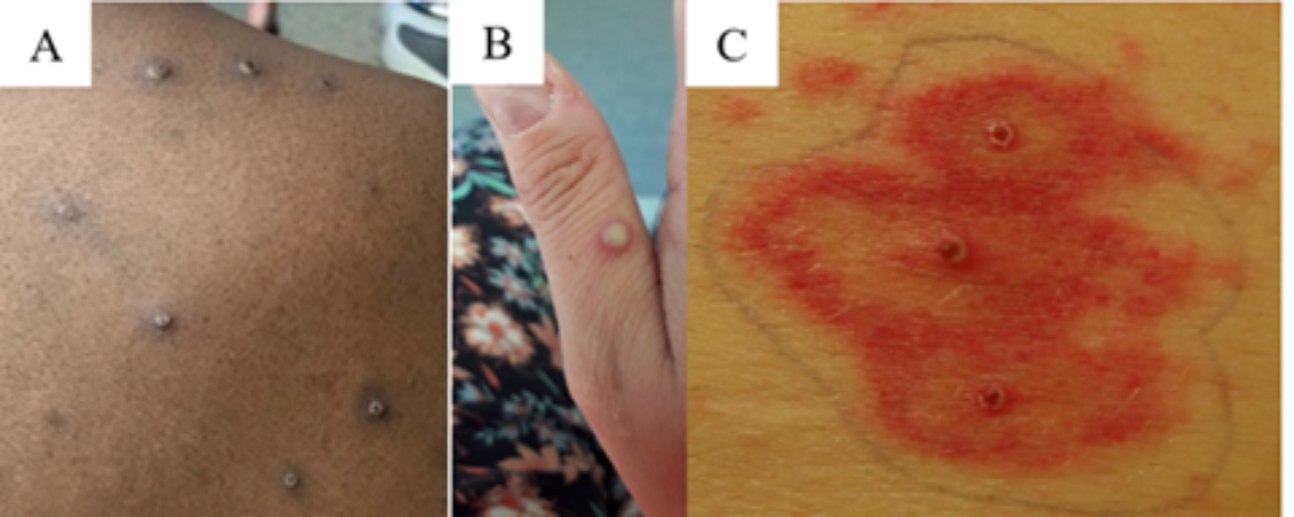 Generalized monkeypox lesions are characteristically deep-seated, well-circumscribed, and often develop umbilication (A, B, C), Image A demonstrates both papulovesicular and pustular lesions in the same region of the body. Credits: Images A and B from NHS England High Consequence Infectious Diseases Network; image C from Reed KD, Melski JW, Graham MB et al. The detection of monkeypox in humans in the Western Hemisphere. Page 346. Copyright © 2004. Massachusetts Medical Society. Reprinted with permission. Please see lesion examples from Nigeria and Italy. ​ ​